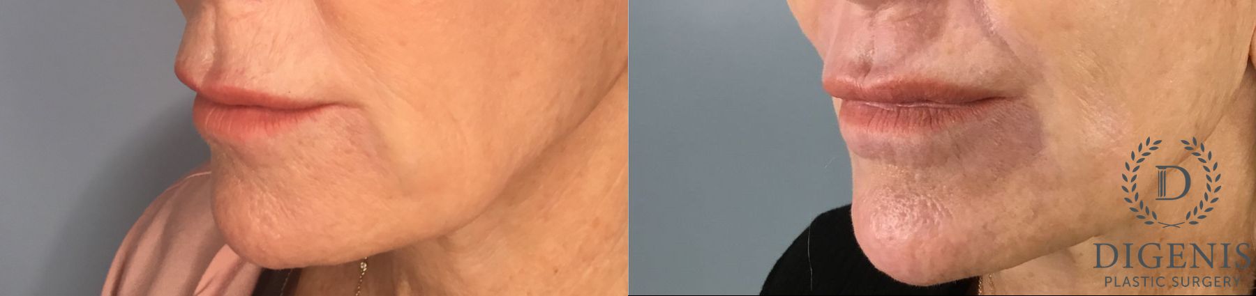 Before and after Laser Skin Resurfacing case 43368 - Angle 2