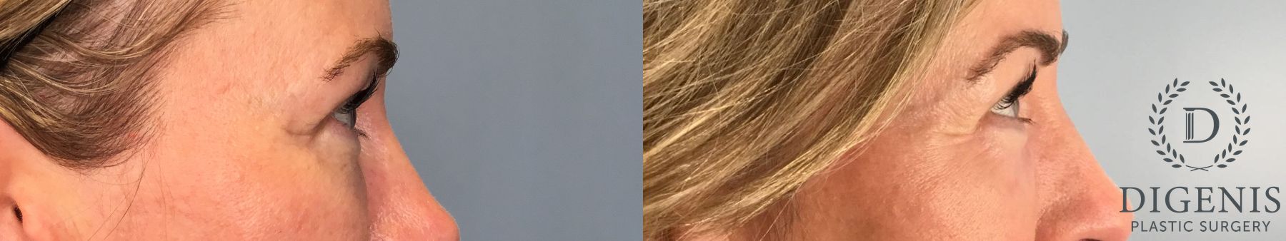 Before and after Laser Skin Resurfacing case 41760 - Angle 5