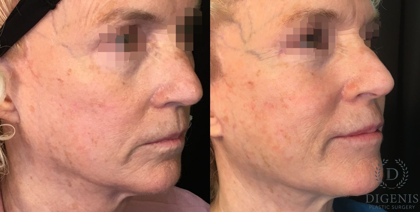 Before and after Laser Skin Resurfacing case 35162 - Angle 2