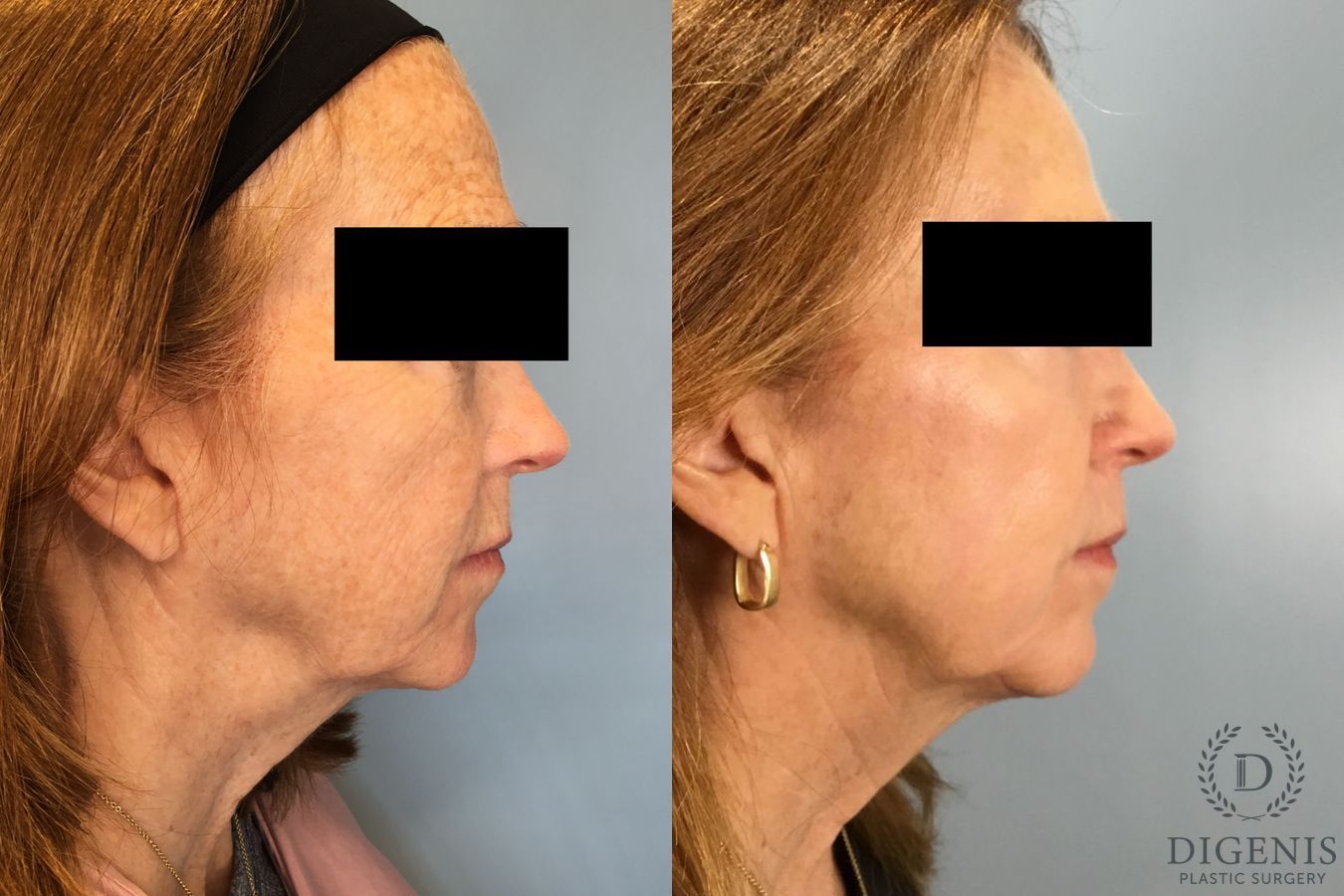 Before and after Laser Skin Resurfacing case 49532 - Angle 5
