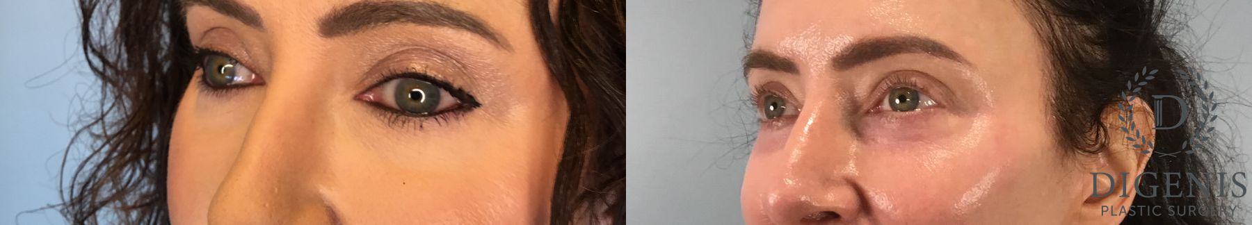 Before and after Laser Skin Resurfacing case 43078 - Angle 2