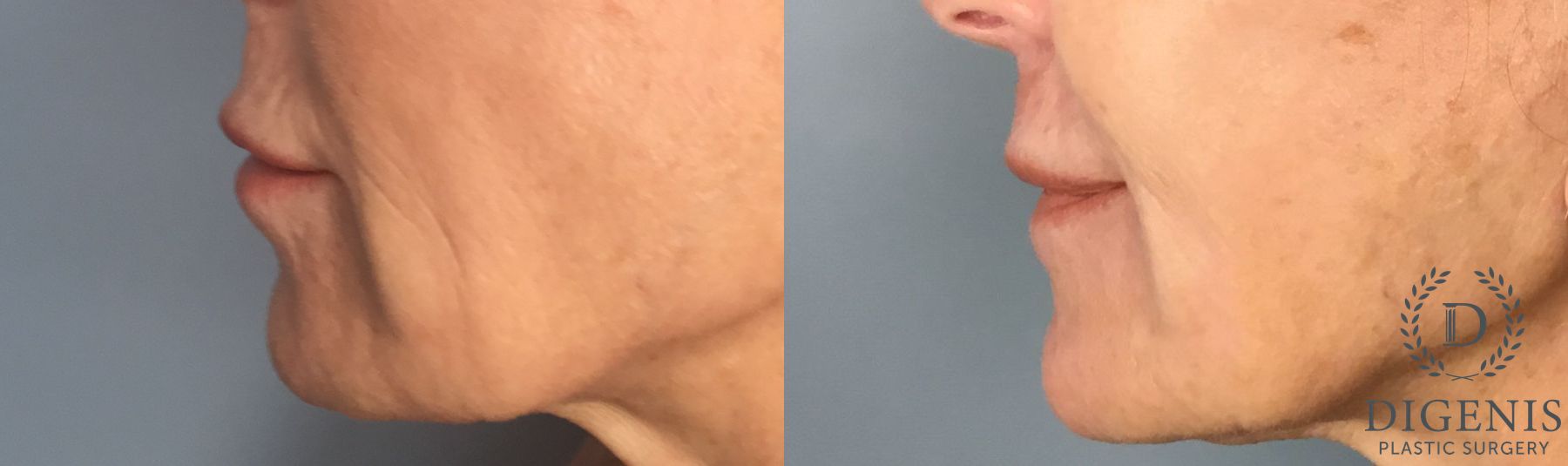 Before and after Laser Skin Resurfacing case 43368 - Angle 3