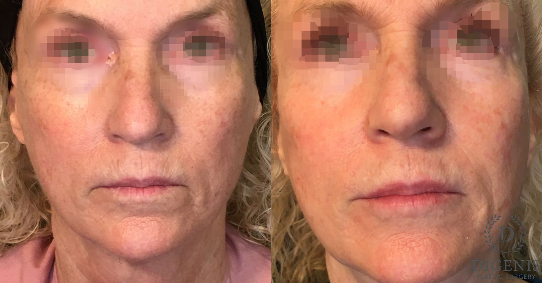 Before and after Laser Skin Resurfacing case 35162