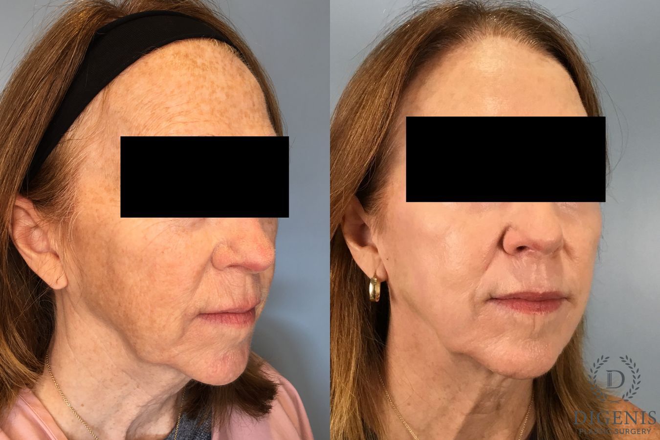 Before and after Laser Skin Resurfacing case 49532 - Angle 4