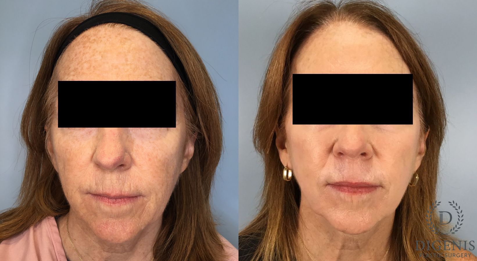 Before and after Laser Skin Resurfacing case 49532