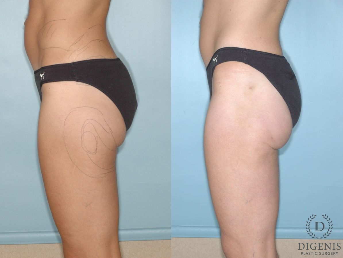 Before and after Liposuction case 35130 - Angle 4