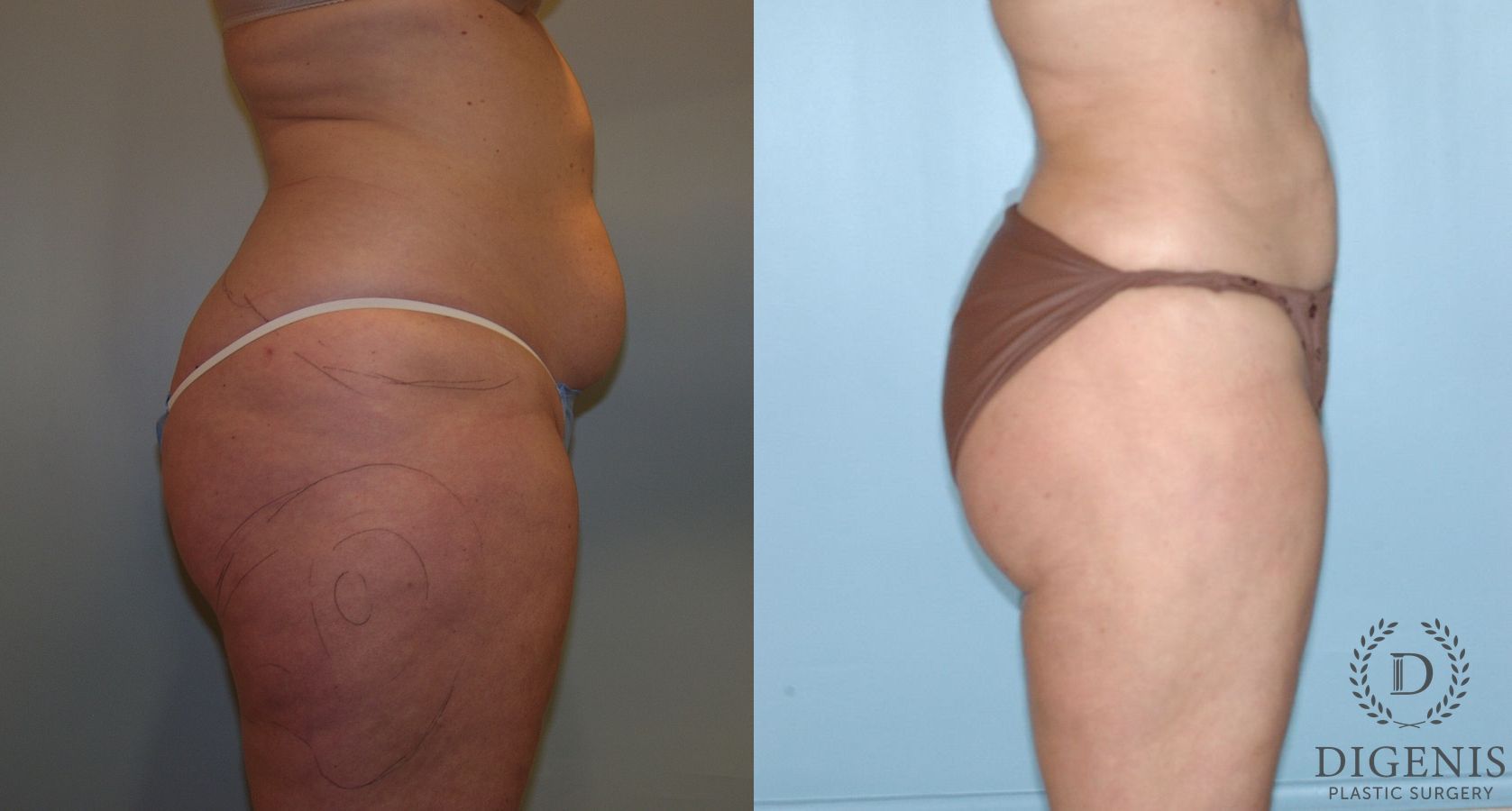 Before and after Liposuction case 35102 - Angle 3