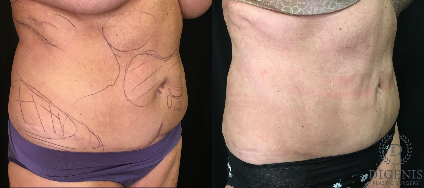 Before and after Liposuction case 35142 - Angle 2