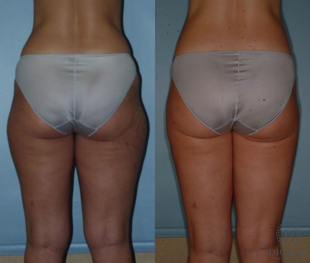 Before and after Liposuction case 35099 - Angle 2