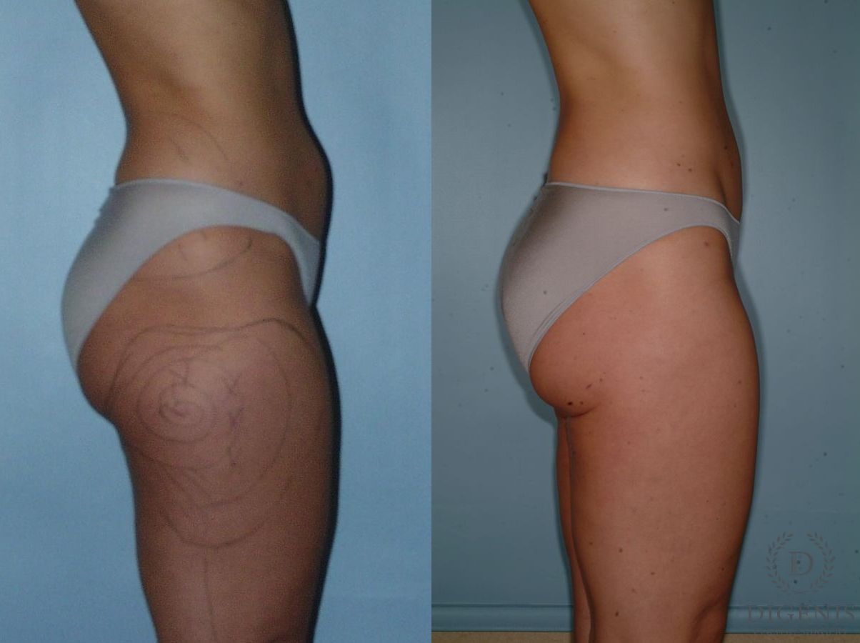 Before and after Liposuction case 35099 - Angle 3