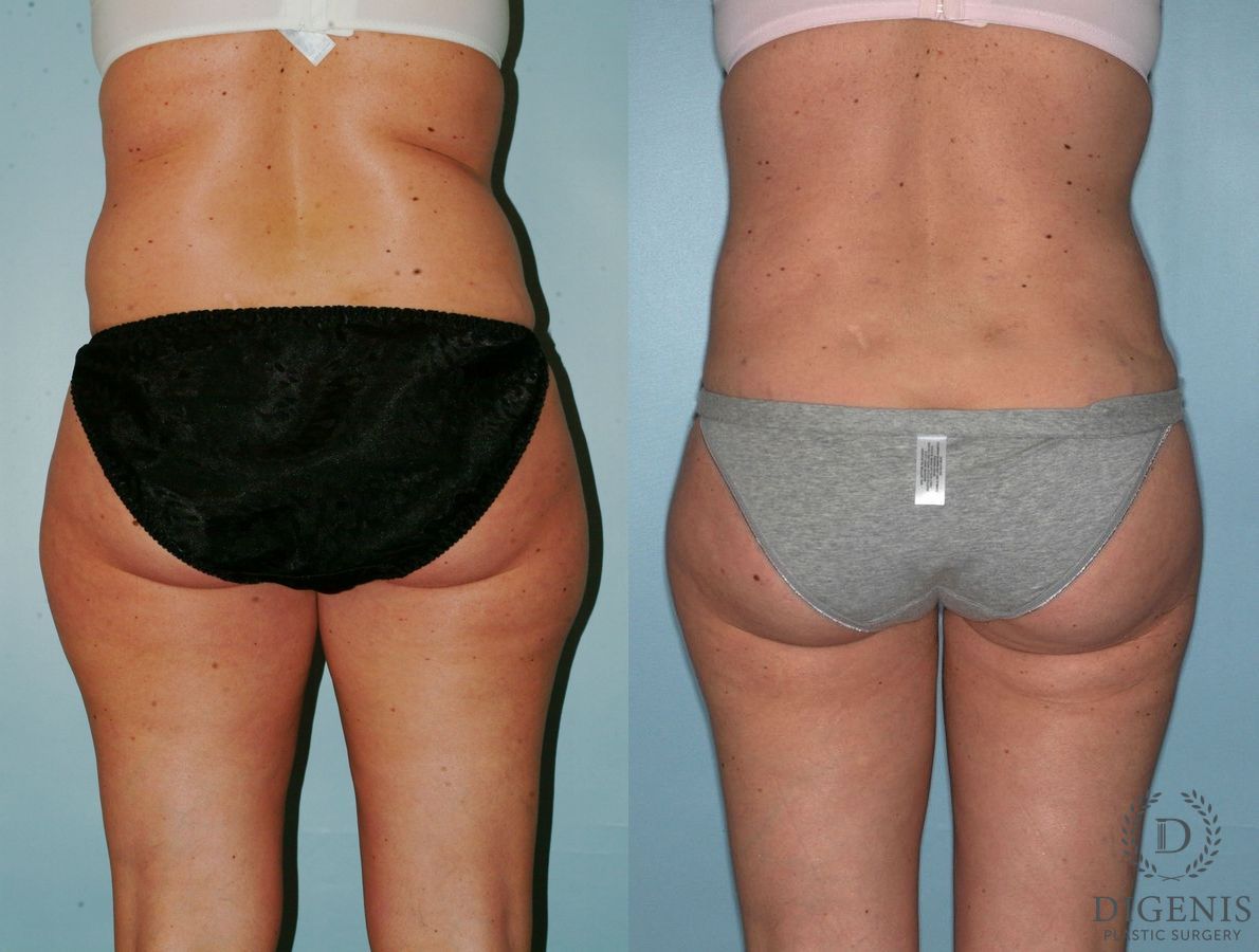 Before and after Liposuction case 35127 - Angle 4