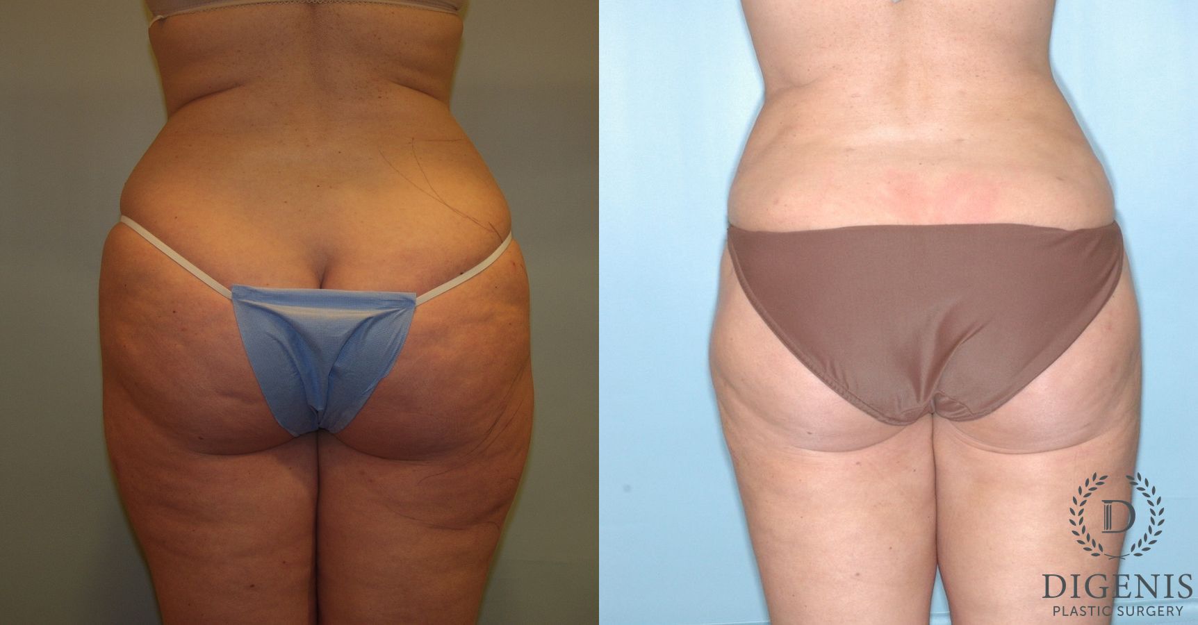 Before and after Liposuction case 35102 - Angle 2