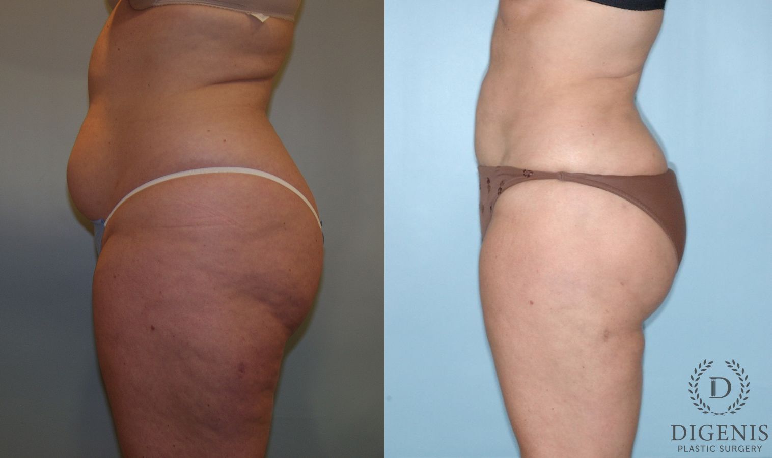 Before and after Liposuction case 35102 - Angle 4