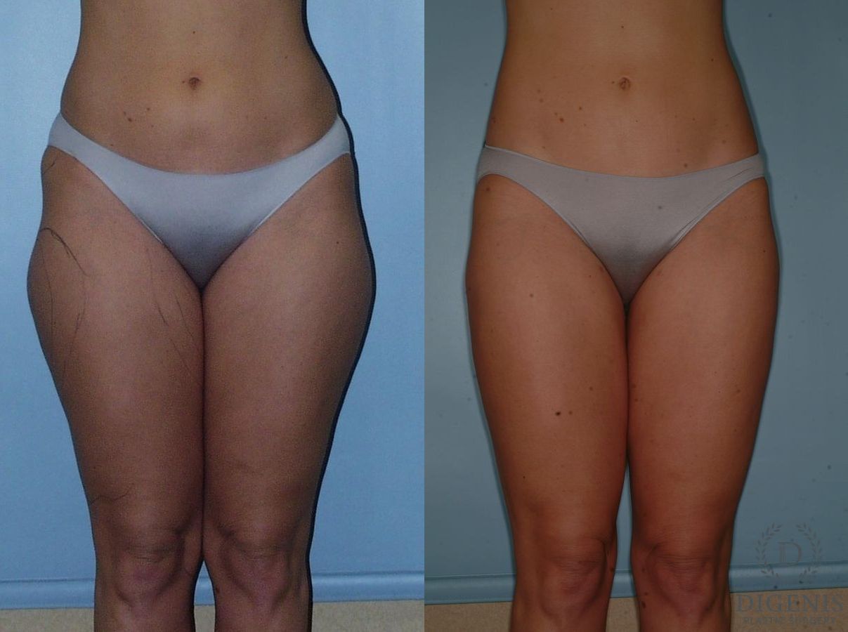 Before and after Liposuction case 35099