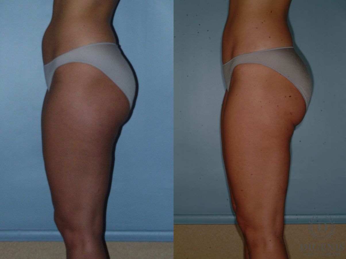 Before and after Liposuction case 35099 - Angle 4
