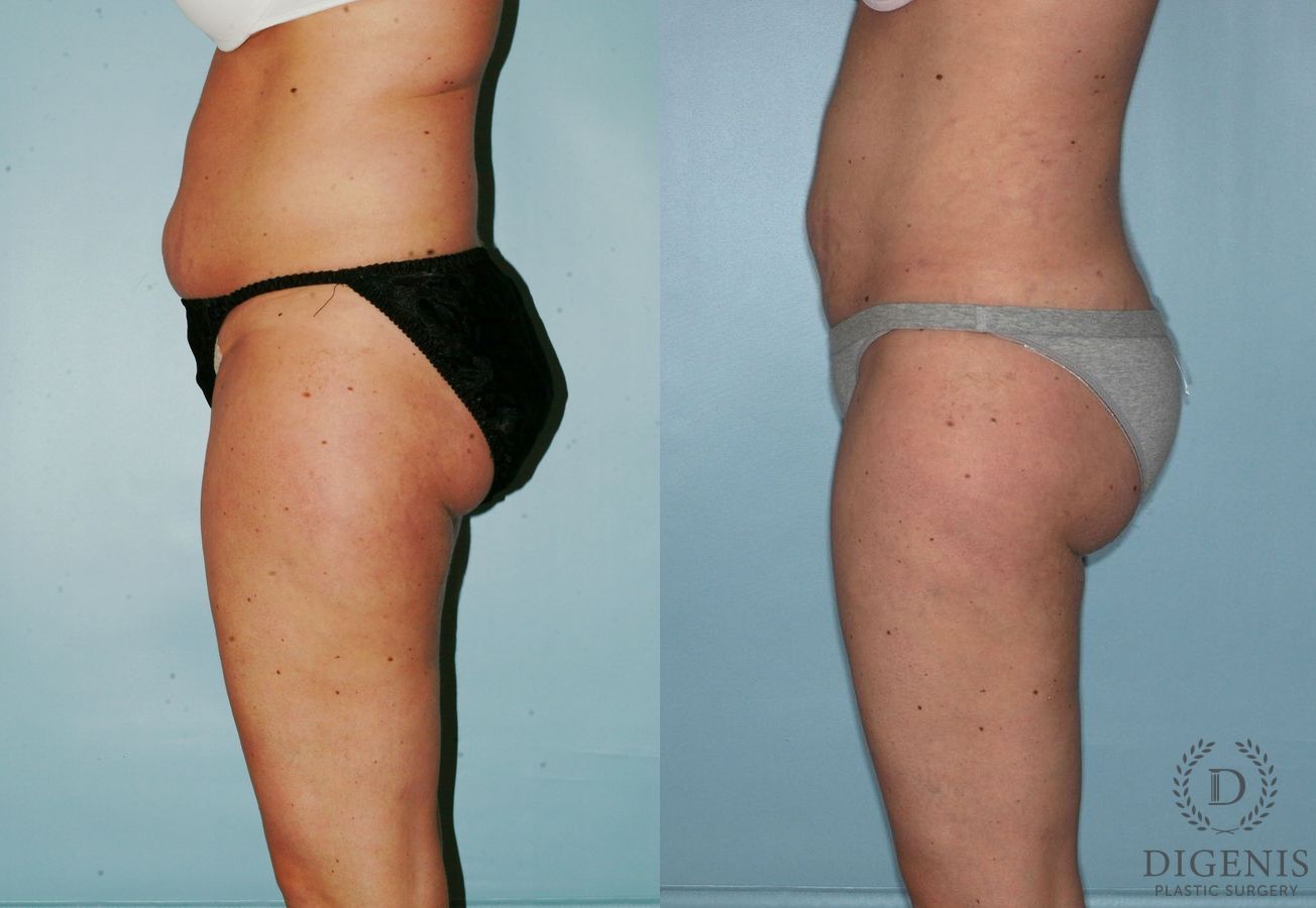 Before and after Liposuction case 35127 - Angle 3