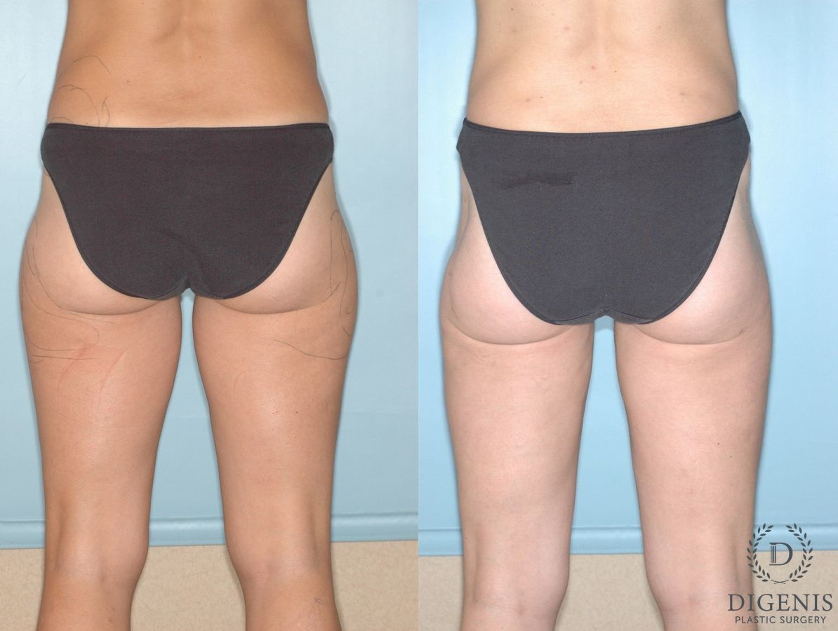 Before and after Liposuction case 35130 - Angle 2