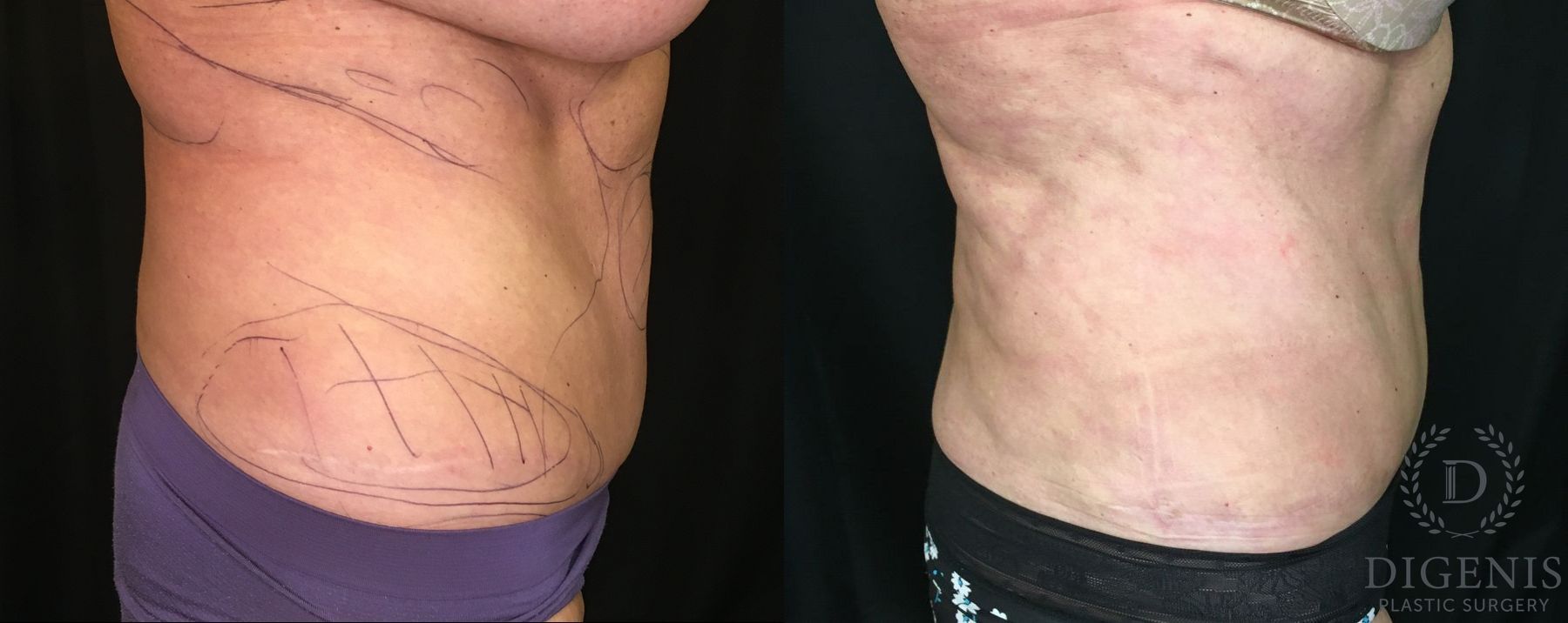 Before and after Liposuction case 35142 - Angle 3