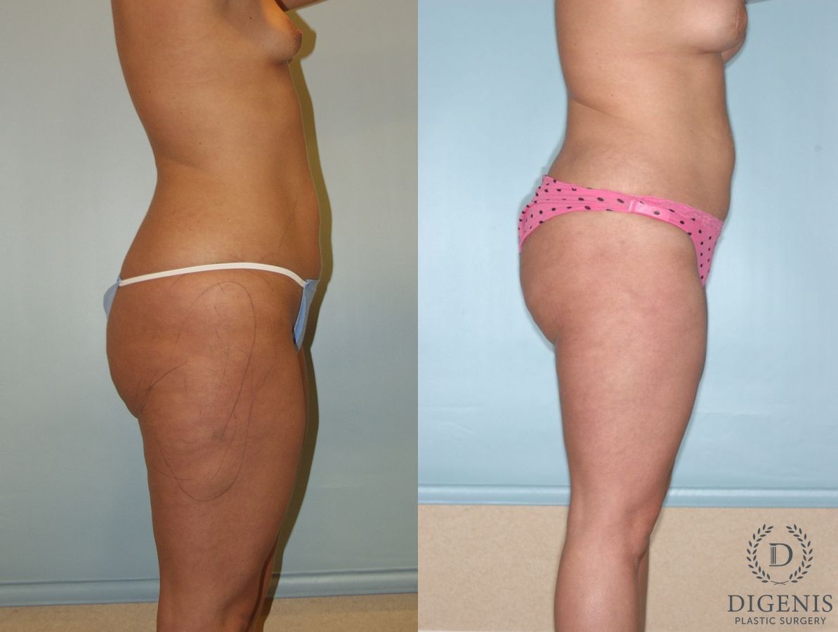 Before and after Liposuction case 35124 - Angle 3