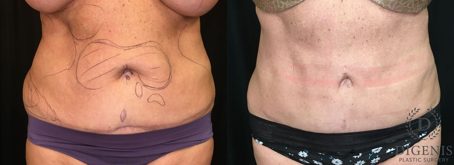 Before and after Liposuction case 35142