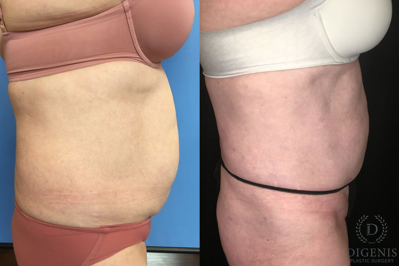 Before and after Liposuction case 35134 - Angle 3