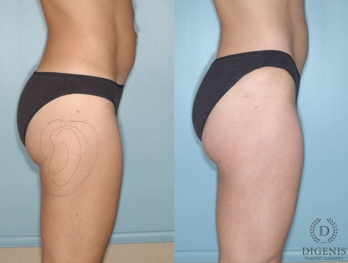 Before and after Liposuction case 35130 - Angle 3