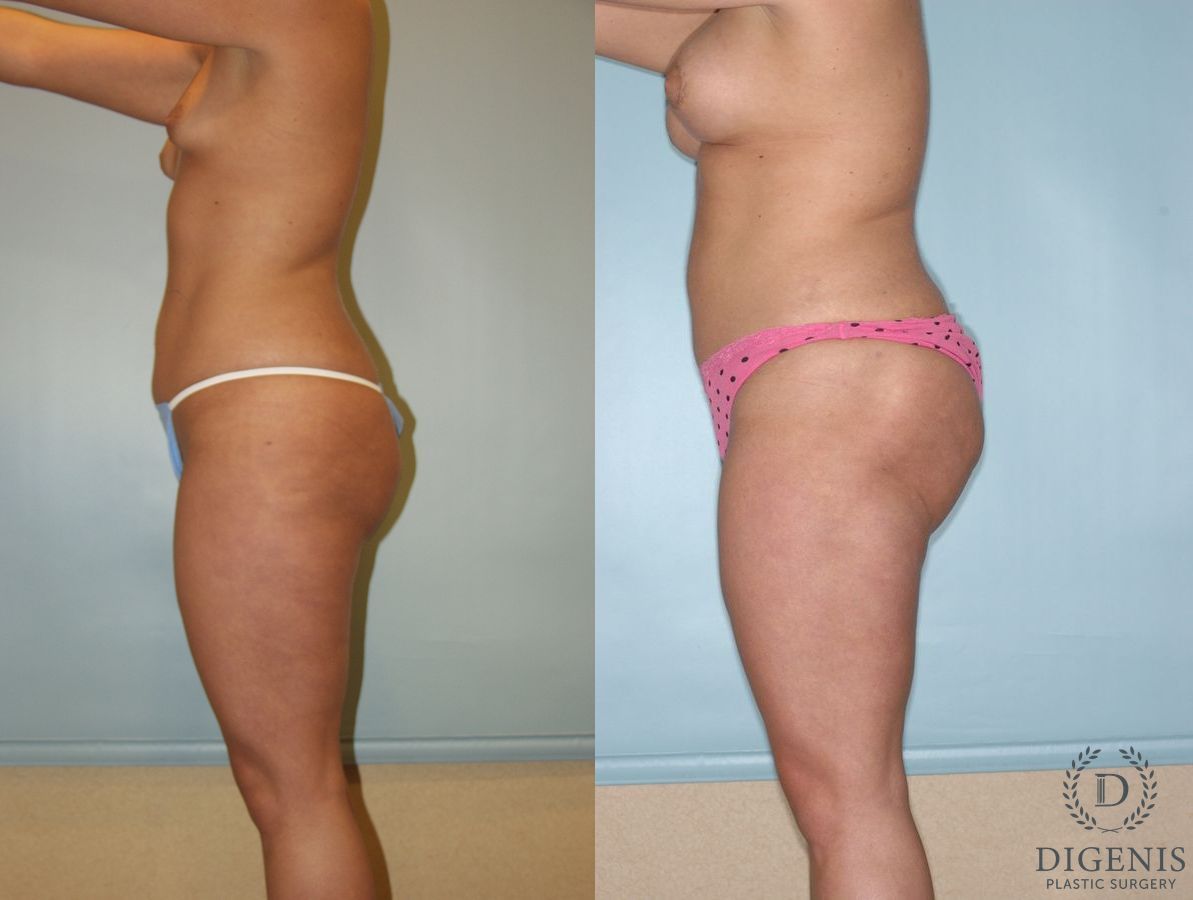 Before and after Liposuction case 35124 - Angle 4