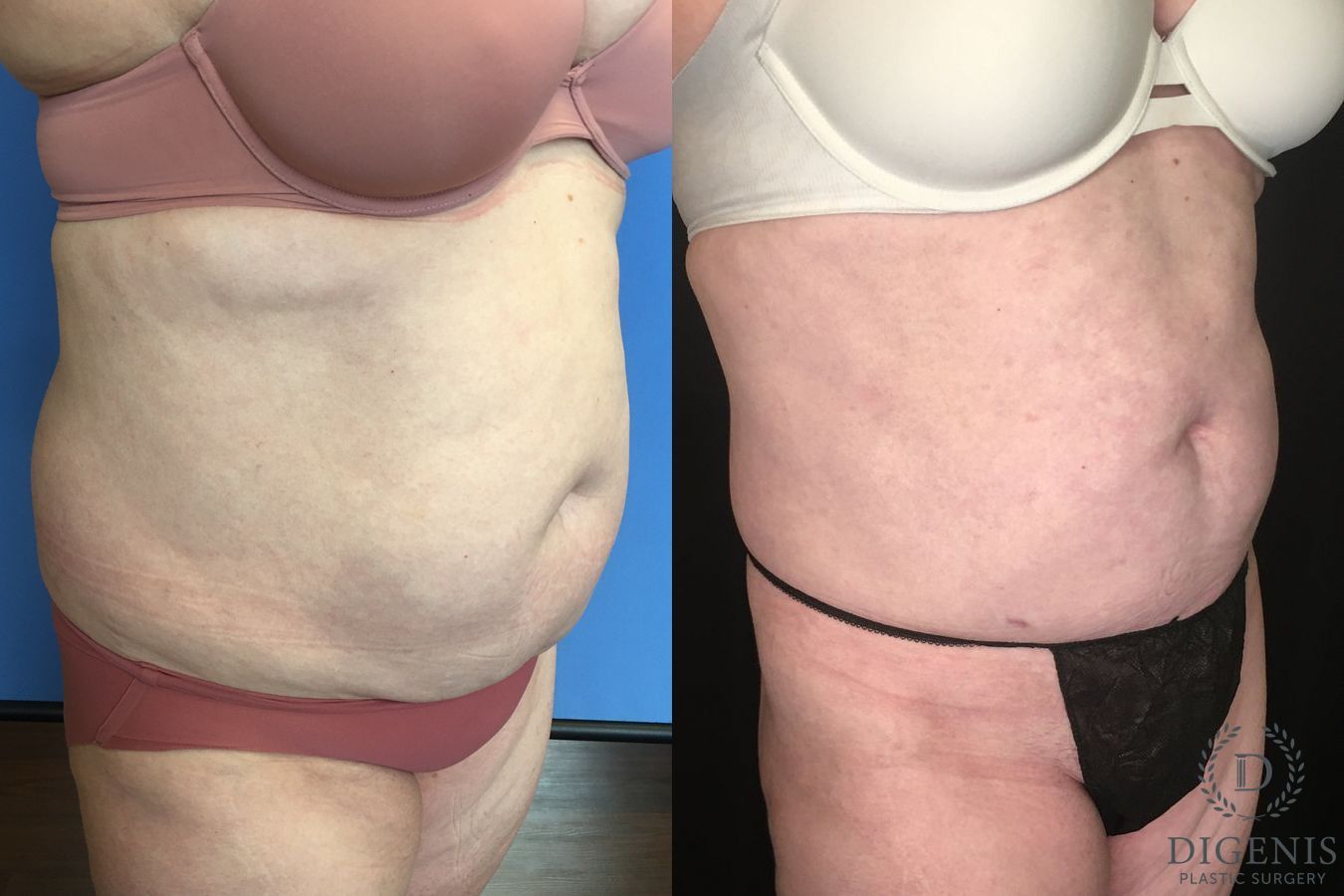 Before and after Liposuction case 35134 - Angle 2