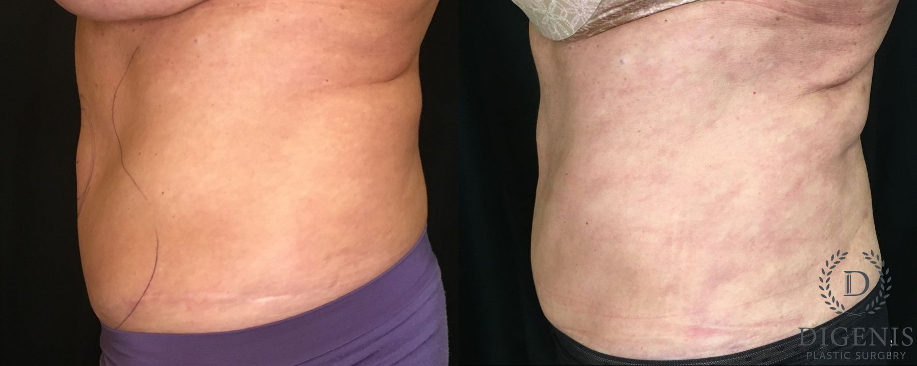 Before and after Liposuction case 35142 - Angle 4