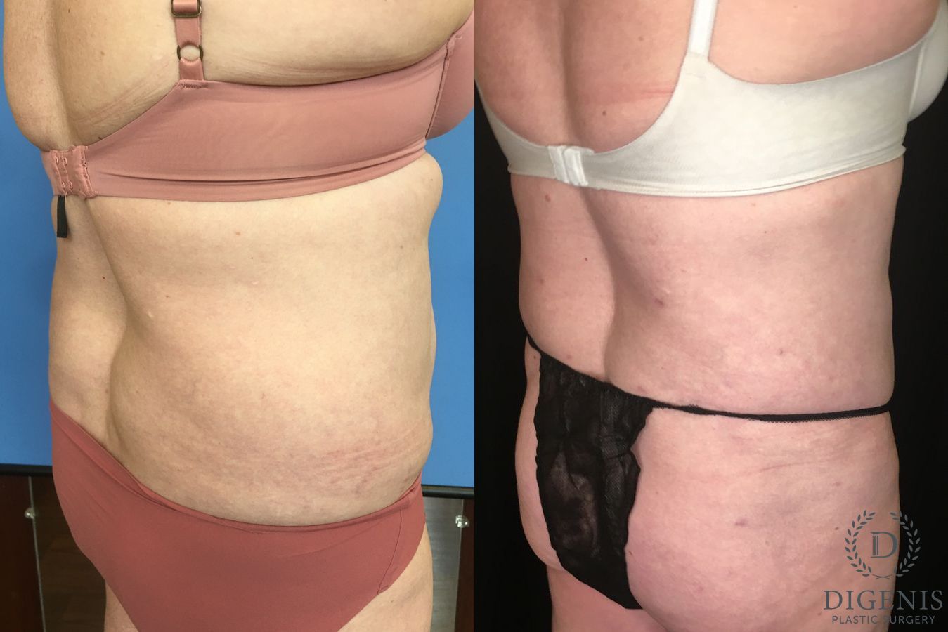 Before and after Liposuction case 35134 - Angle 4