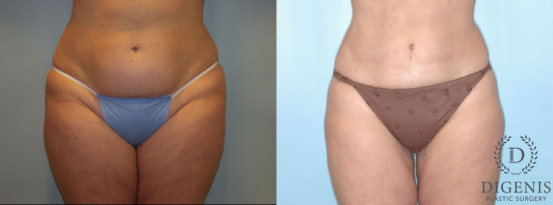 Before and after Liposuction case 35102