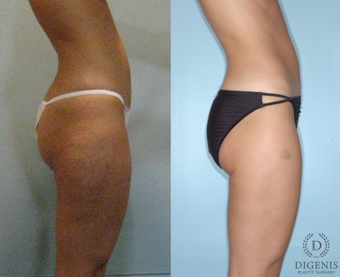 Before and after Liposuction case 35103 - Angle 3