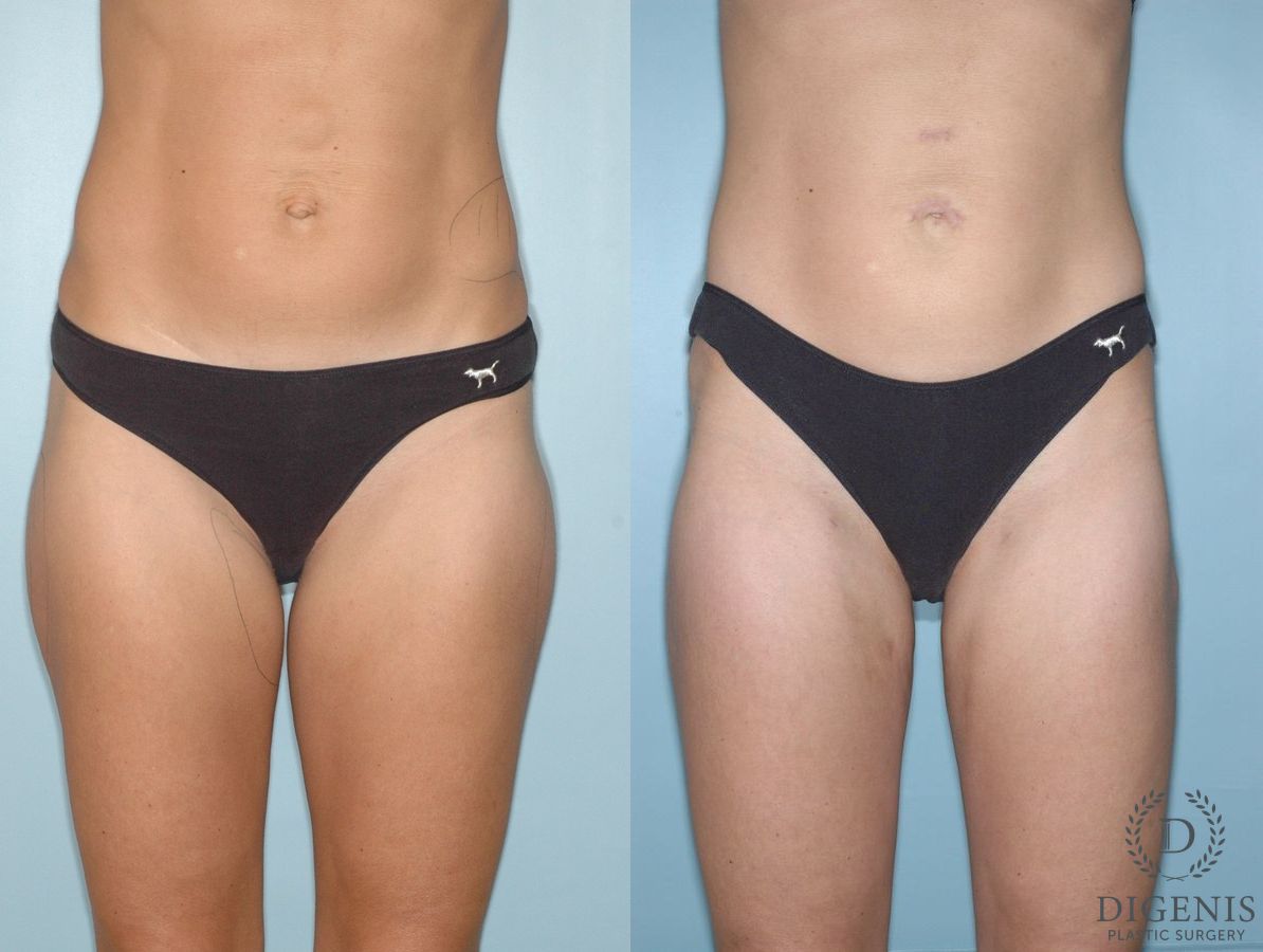 Before and after Liposuction case 35130