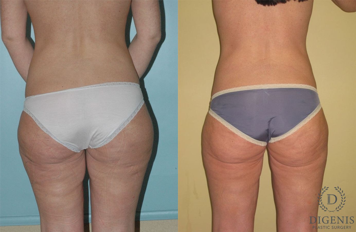 Before and after Liposuction case 35039 - Angle 2