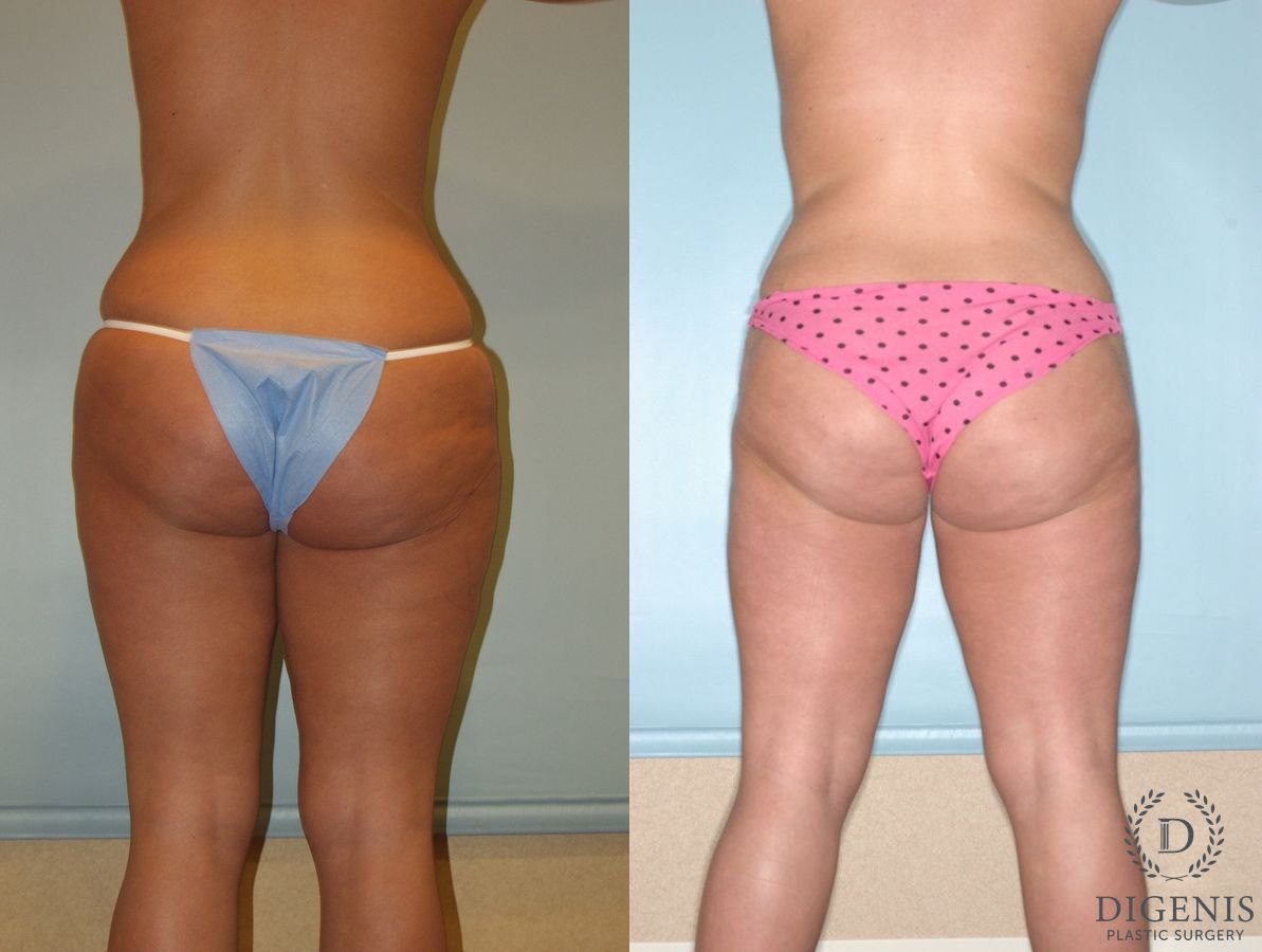 Before and after Liposuction case 35124 - Angle 2