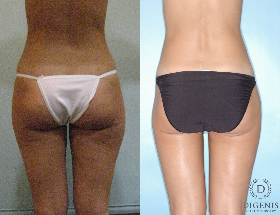 Before and after Liposuction case 35103 - Angle 2