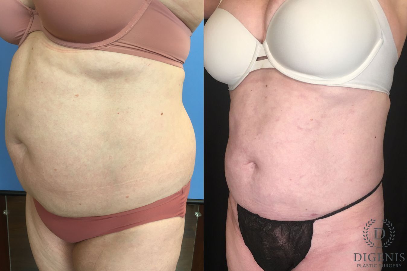 Before and after Liposuction case 35134 - Angle 5