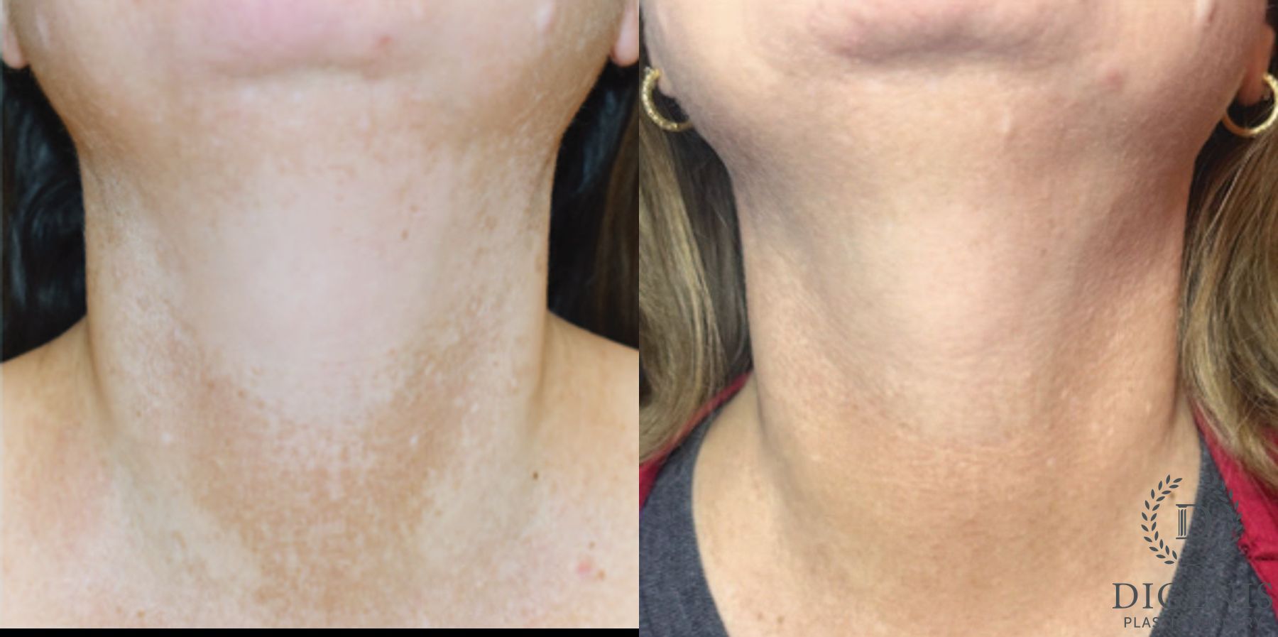 Before and after MOXI Light Laser case 41683