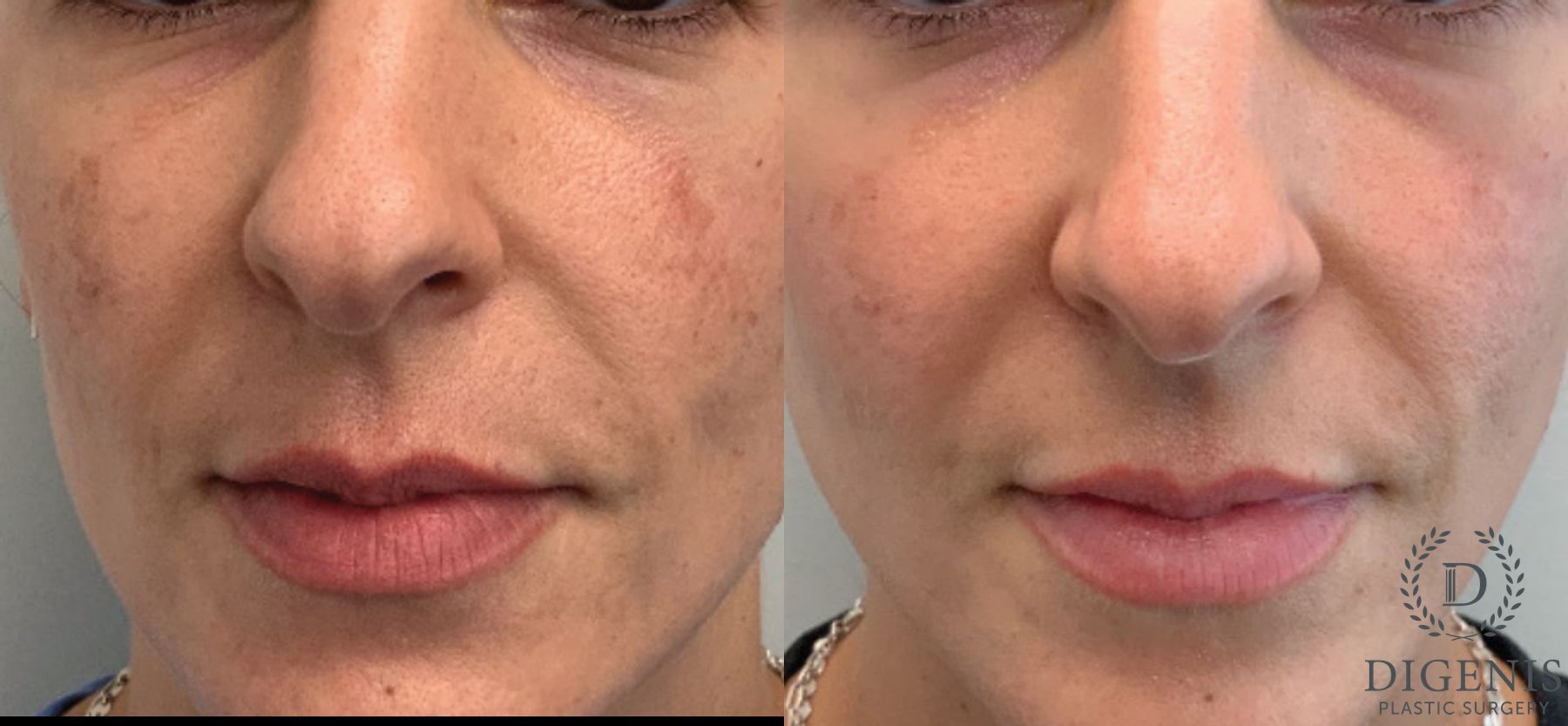 Before and after MOXI Light Laser case 41690
