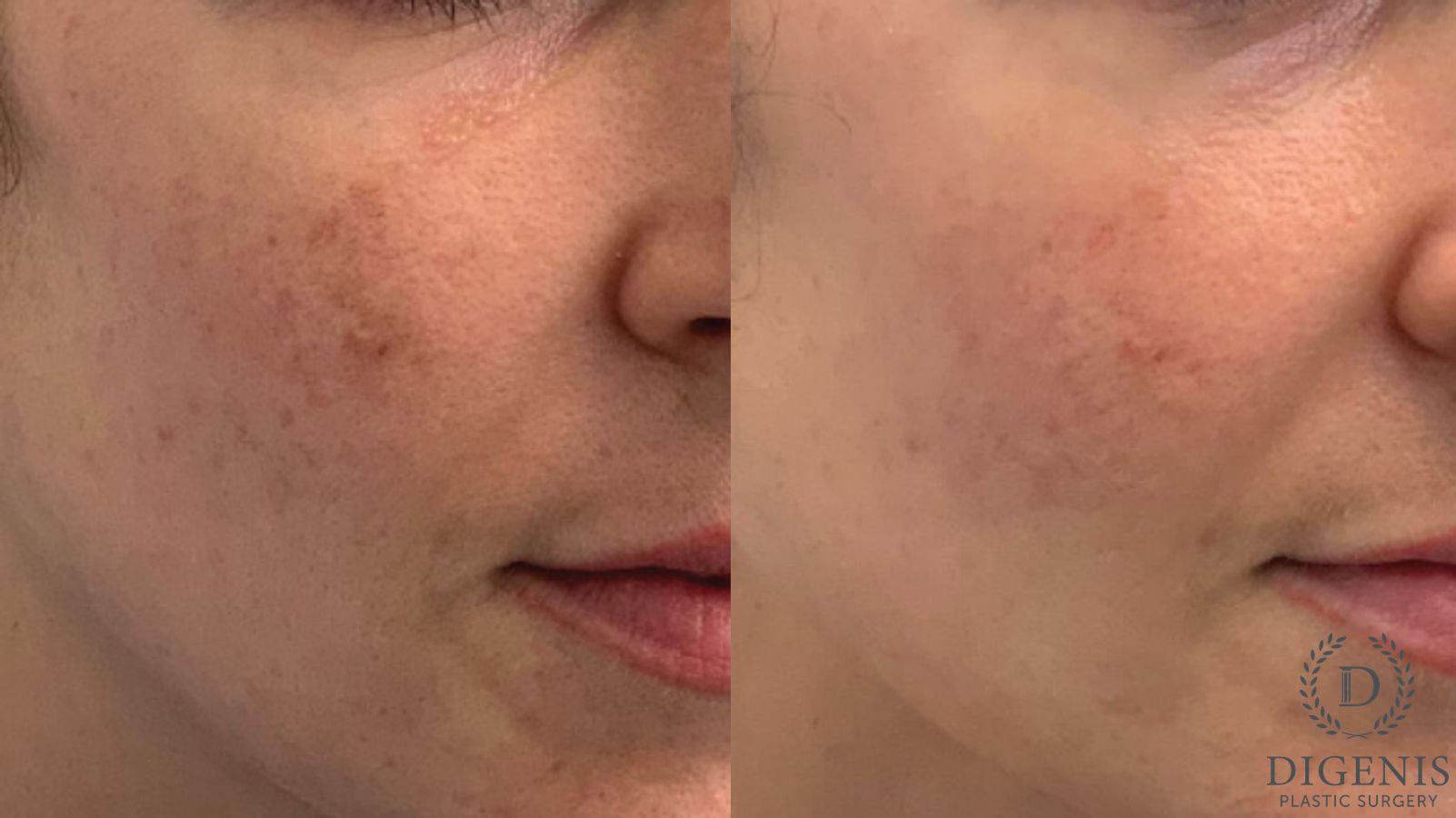 Before and after MOXI Light Laser case 41686