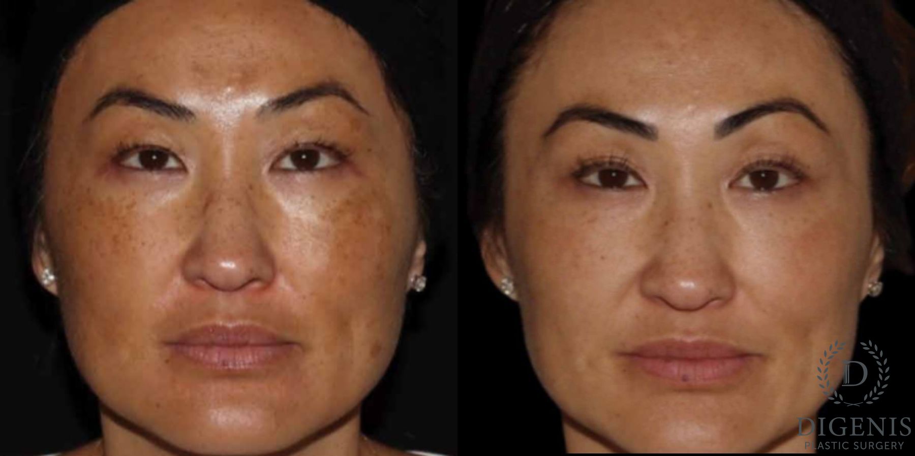 Before and after MOXI Light Laser case 41687