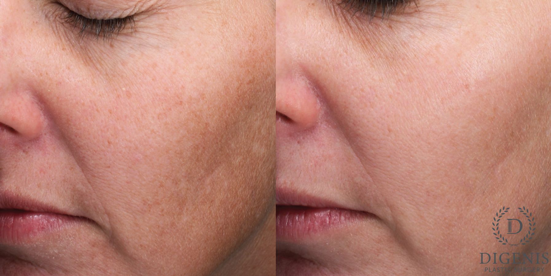 Before and after MOXI Light Laser case 41685
