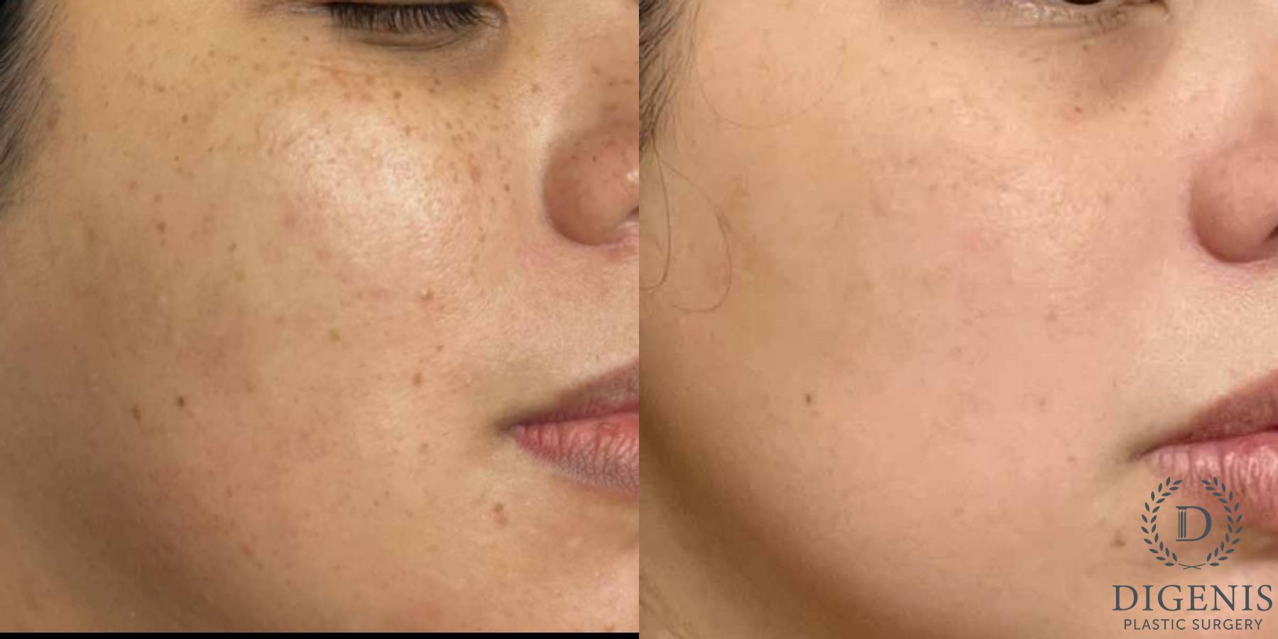 Before and after MOXI Light Laser case 41689