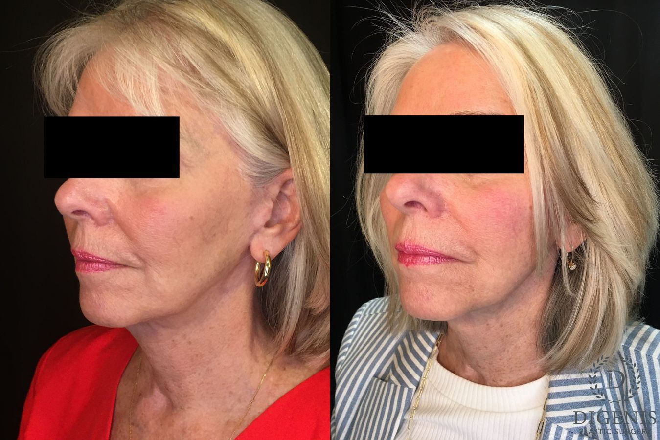 Before and after Temple Lift case 35194 - Angle 4