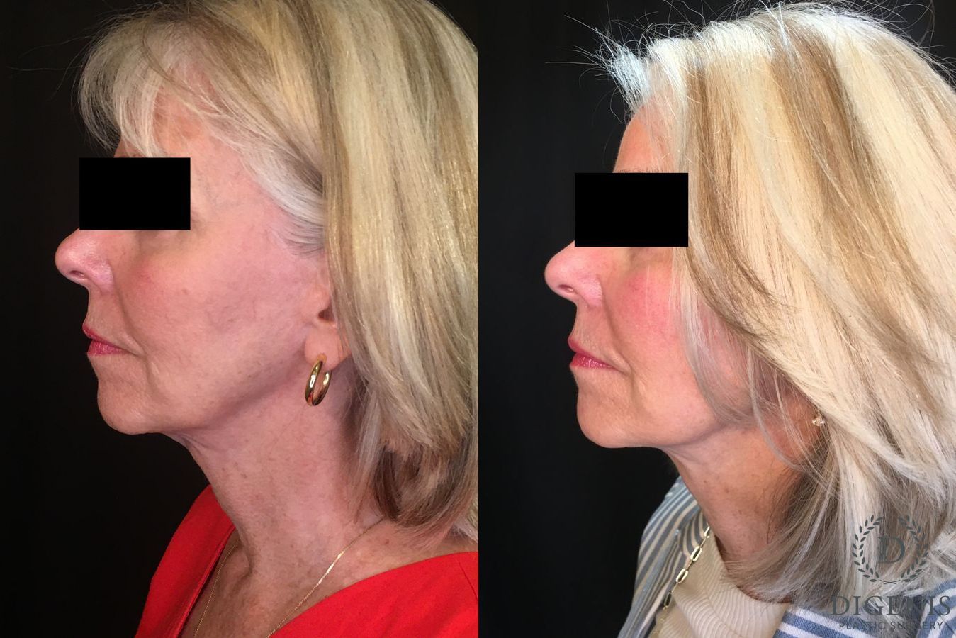 Before and after Temple Lift case 35194 - Angle 5