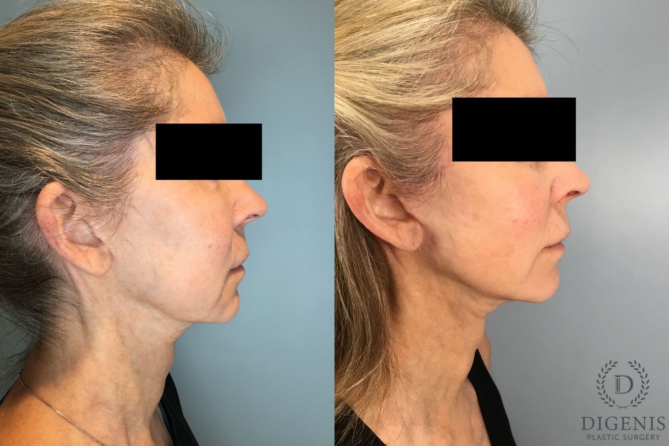 Before and after Temple Lift case 46416 - Angle 3