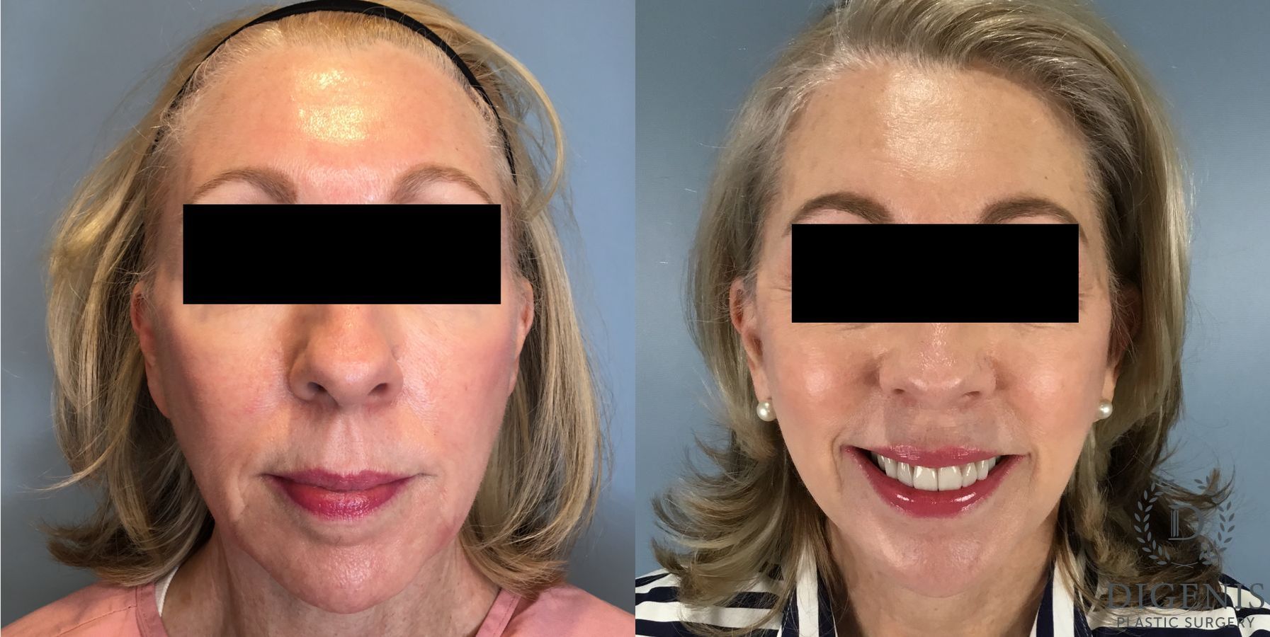 Before and after Temple Lift case 41711