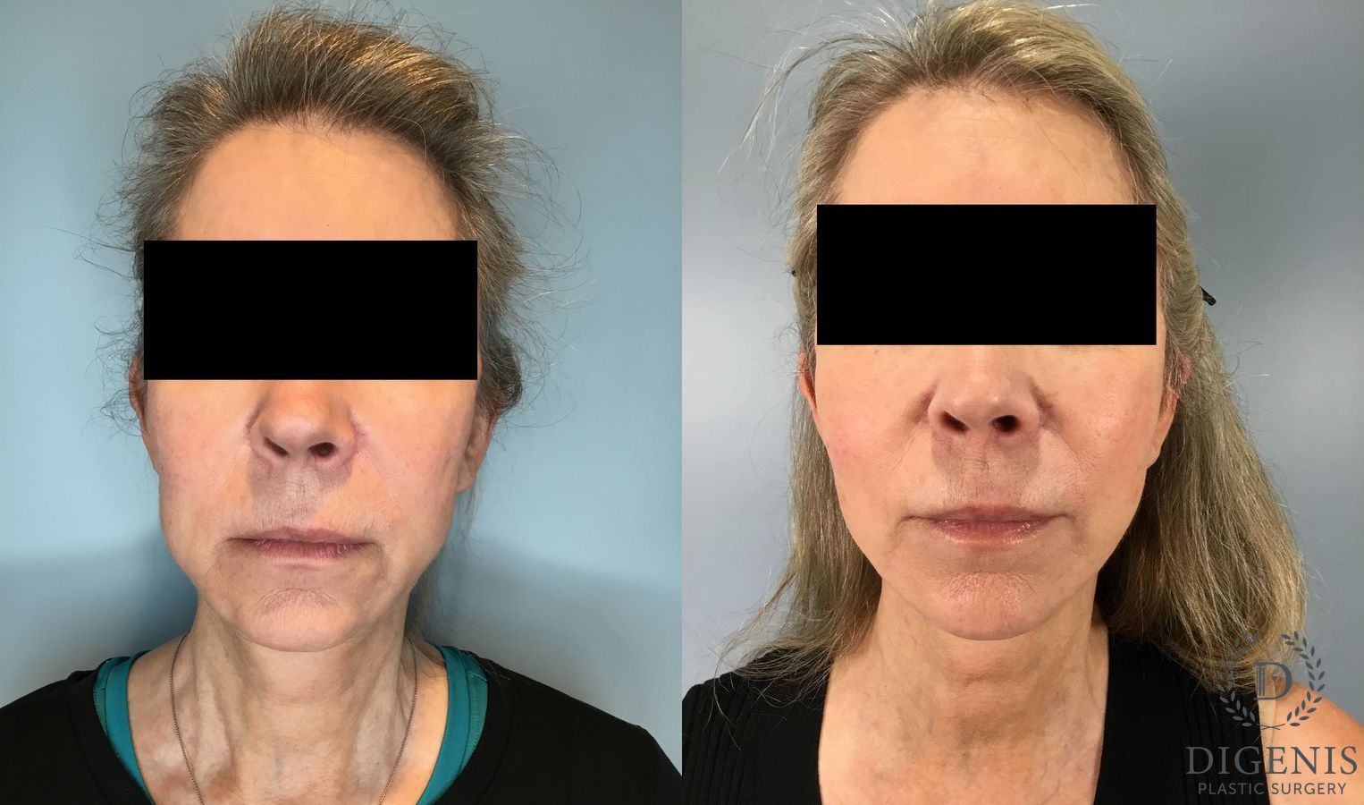 Before and after Temple Lift case 46416