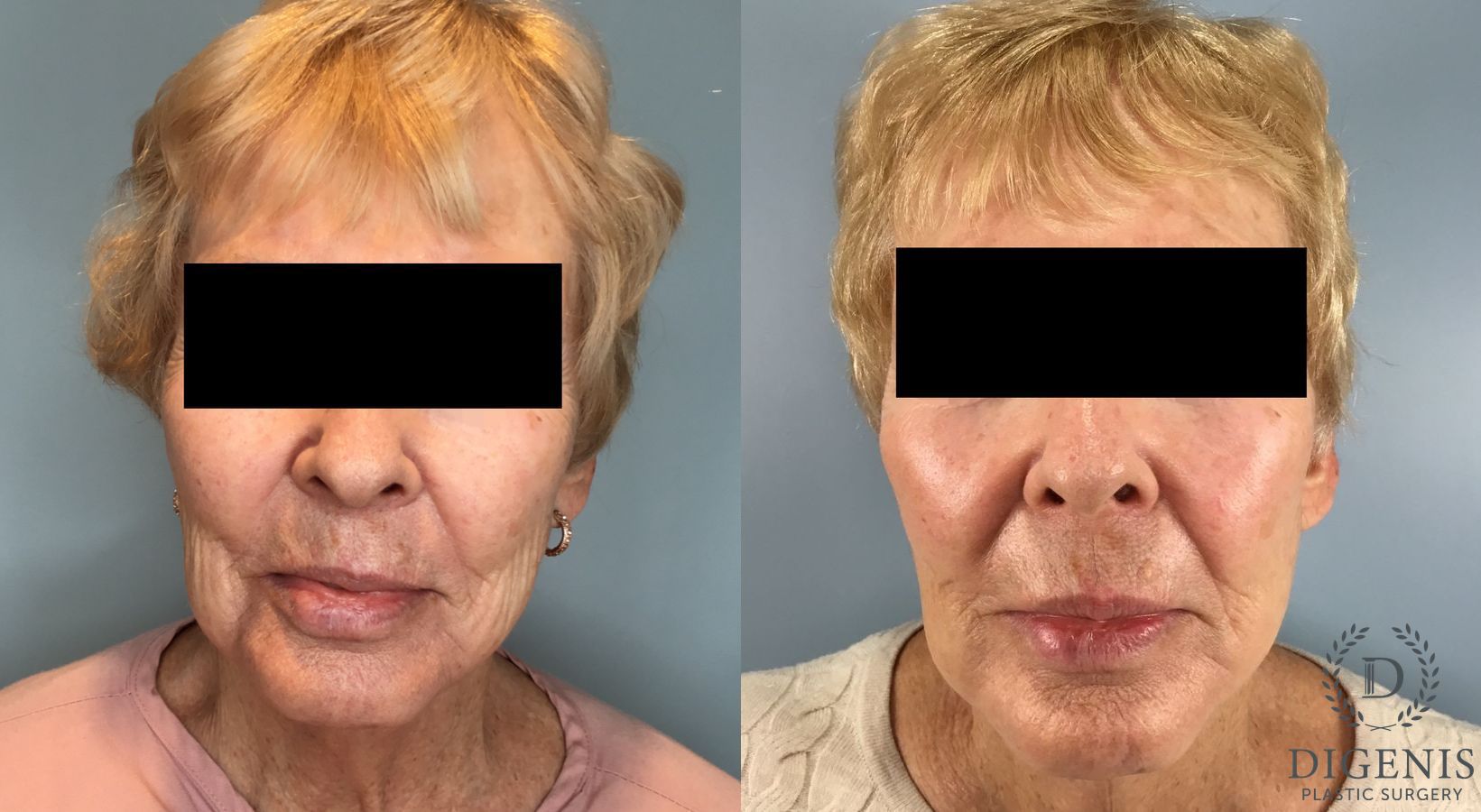 Before and after Temple Lift case 43450
