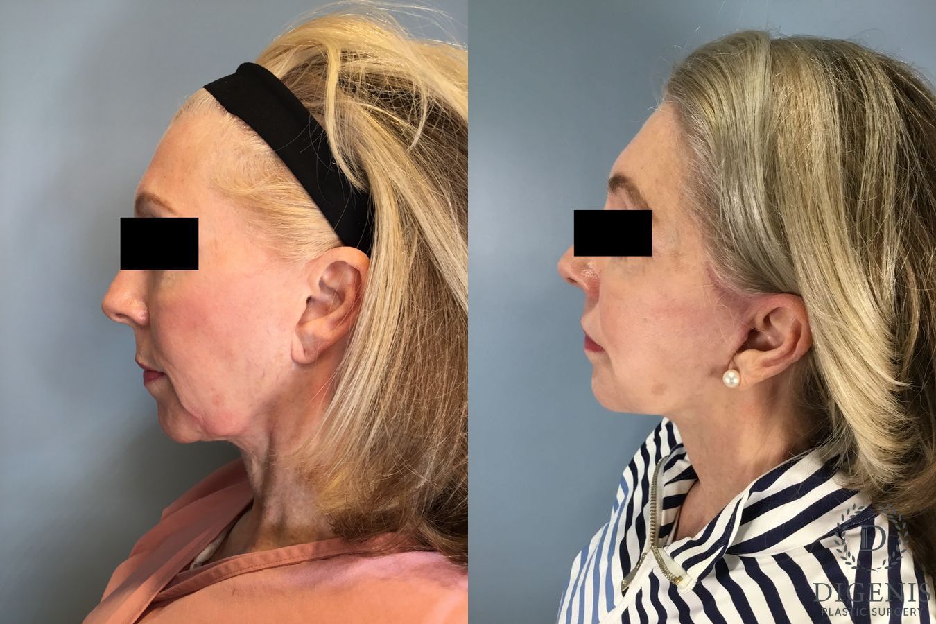 Before and after Temple Lift case 41711 - Angle 3